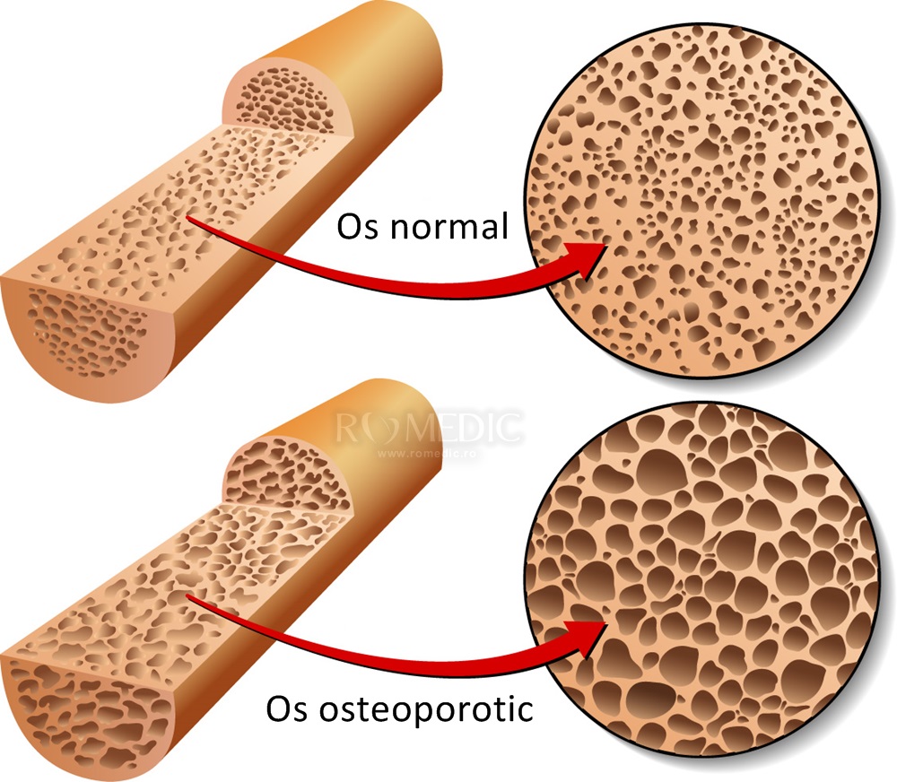 „Ziua Mondială a Osteoporozei”