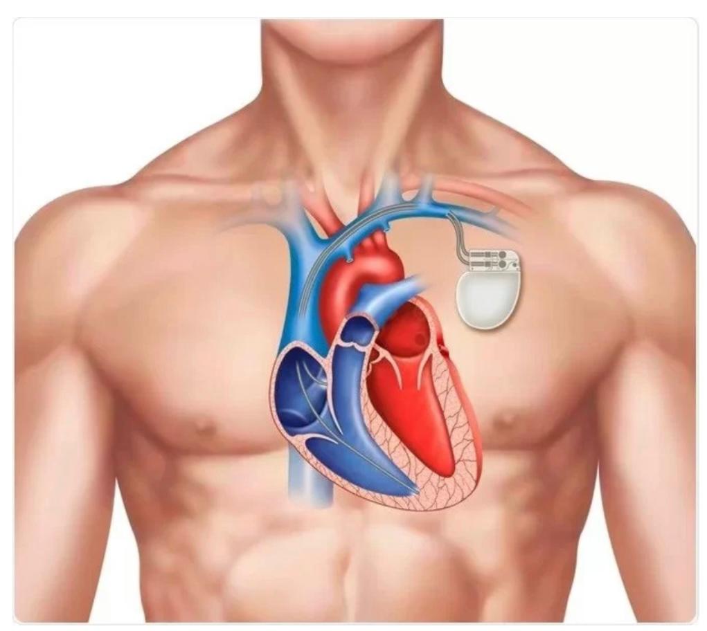 Suceava: Primul implant de stimulatoare cardiace permanente la Spitalul Judeţean